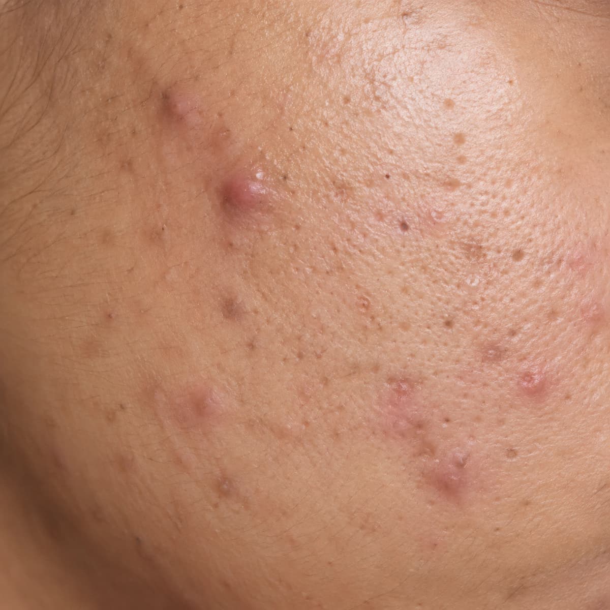 Close-up skin sample for Acne System