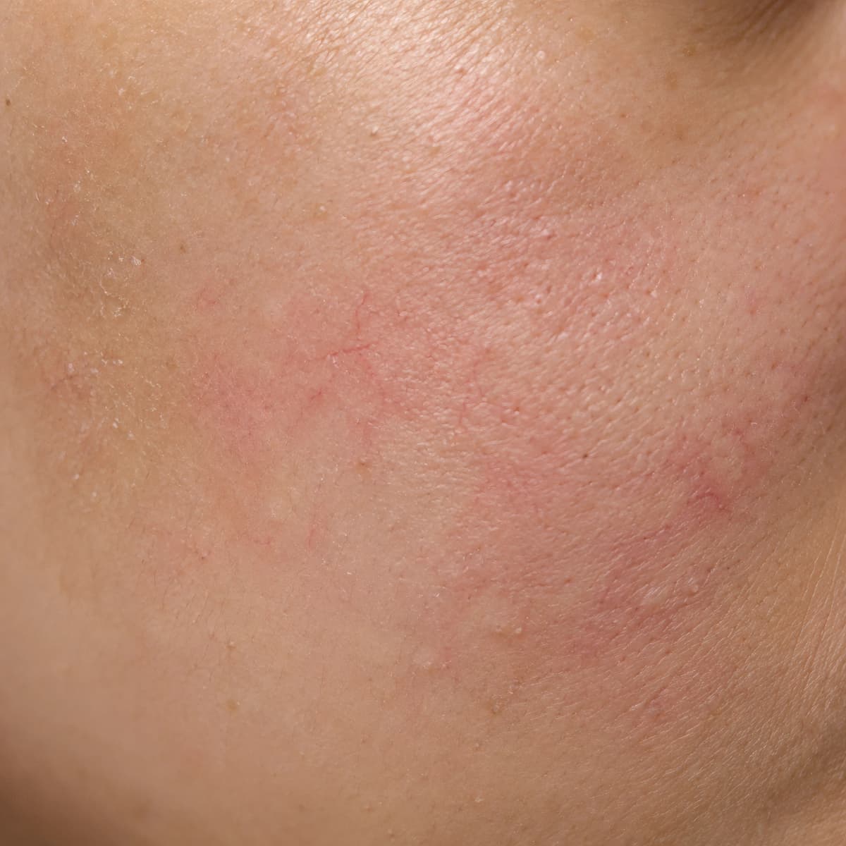 Close-up skin sample for Sensitive Skin System