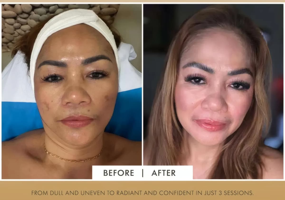 VCM patient result, after